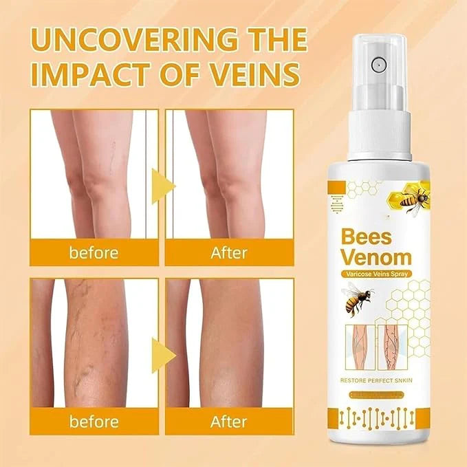 Bee Venon Varicose Veins Spray - BUY 1 GET 1 FREE